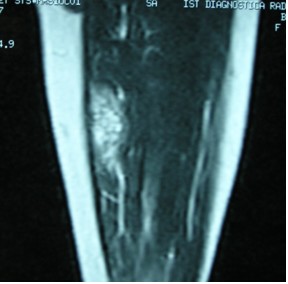 Angioma della gamba