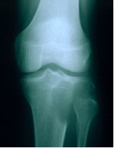Aspetto tipico di un TCG della metaepifisi prossimale della tibia.