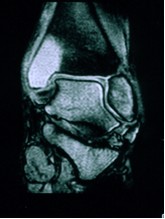 TCG della tibia distale e del malleolo mediale