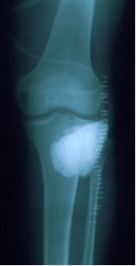 Trattamento di curettage e borraggio con cemento.