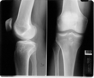 Condroma della metafisi prossimale della tibia