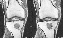 Condroma della metafisi prossimale della tibia