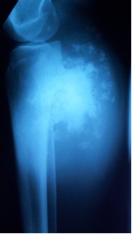 Condrosarcoma Periferico della tibia