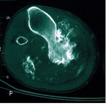 Condrosarcoma Periferico della tibia