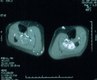 Fibromatosi aggressiva della gamba destra.