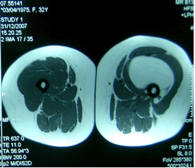 Lipoma della coscia destra.