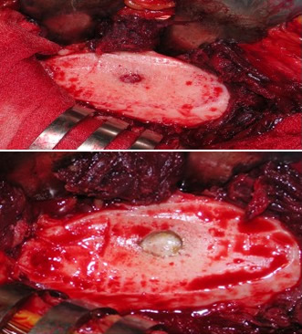 Individuazione intraoperatoria del nidus e sua asportazione