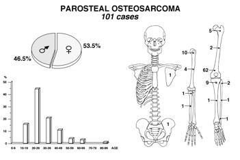 Osteosarcoma Parostale