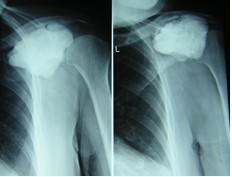 Osteosarcoma Parostale della clavicola