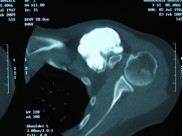 Osteosarcoma Parostale della clavicola
