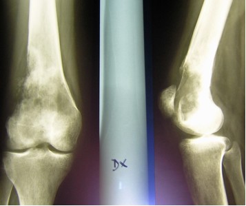 Osteosarcoma Emorragico della metafisi distale del femore destro