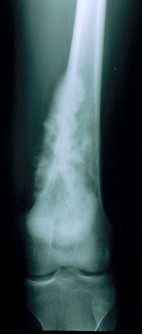 Osteosarcoma Classico del femore distale prima della chemioterapia preoperatoria