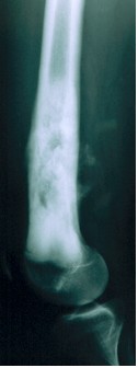 Osteosarcoma Classico del femore distale prima della chemioterapia preoperatoria