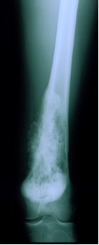 Osteosarcoma Classico del femore distale dopo la chemioterapia preoperatoria