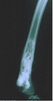 Osteosarcoma Classico del femore distale dopo la chemioterapia preoperatoria