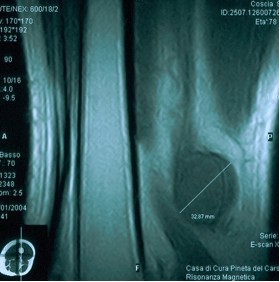 Schwannoma della coscia.